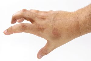 Can You Get Rid of Age Spots - freckles treatment in kenner - mendoza medical clinic