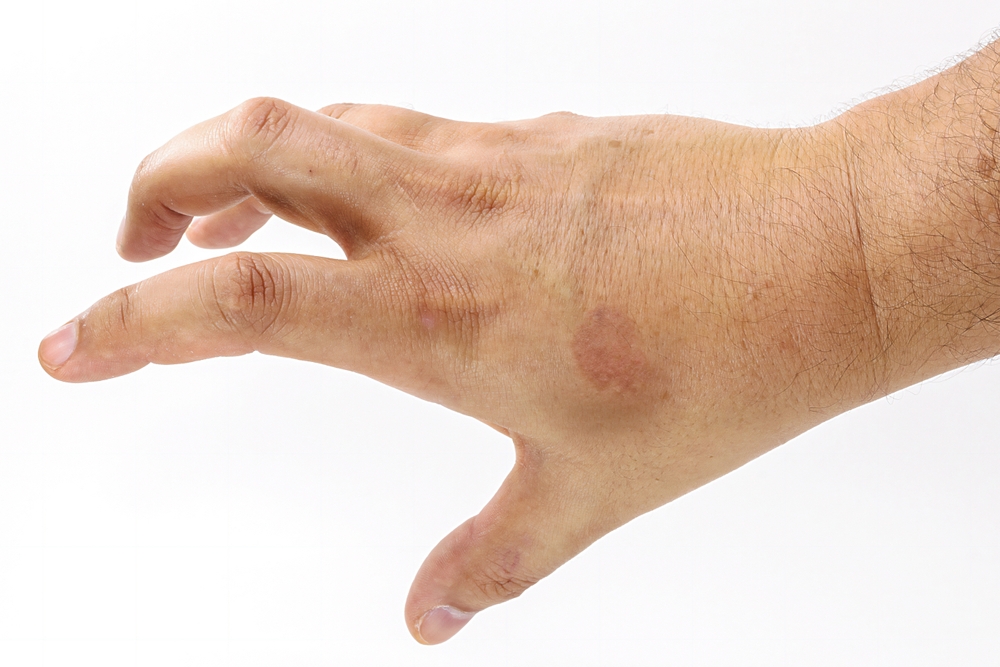 Can You Get Rid of Age Spots - freckles treatment in kenner - mendoza medical clinic