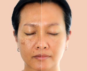 Can You Repair Sun Damage - freckles treatment in kenner - mendoza medical clinic