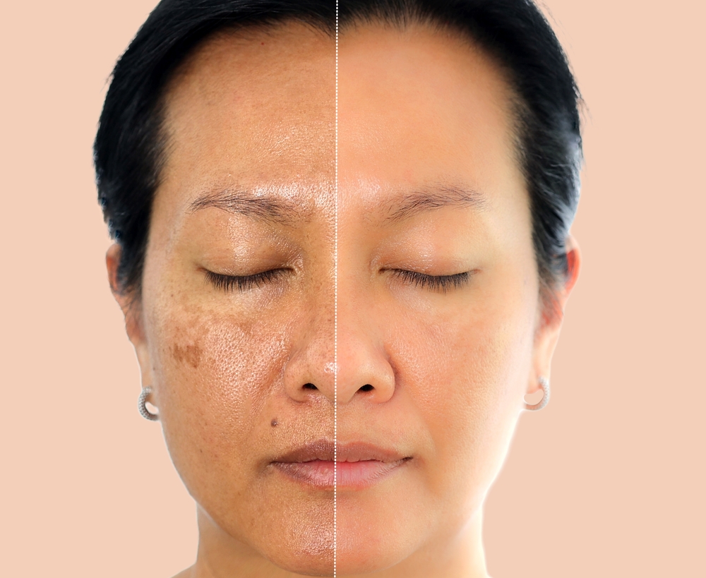 Can You Repair Sun Damage - freckles treatment in kenner - mendoza medical clinic