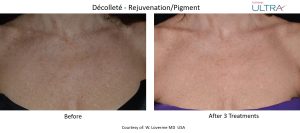 LaseMD Ultra vs Traditional Laser Treatments What’s the Difference - family clinic in kenner - mendoza medical clinic