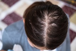 Cuánta caída del cabello es demasiada- medical clinic in kenner - mendoza