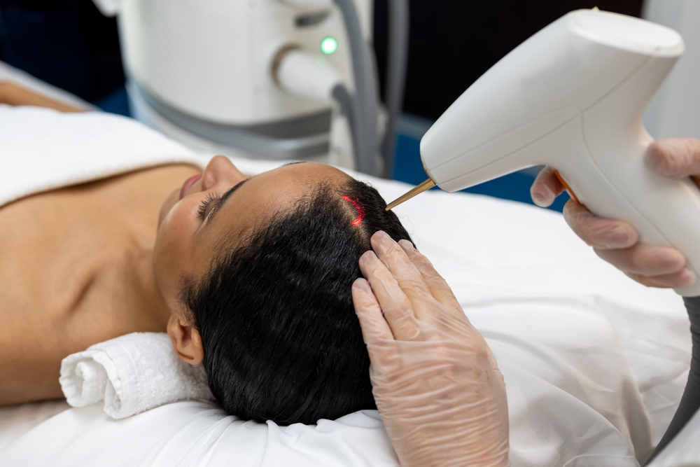 Qué debes saber antes de probar el tratamiento láser para la caída del cabello - clinica hispana en kenner - mendoza medical clinic