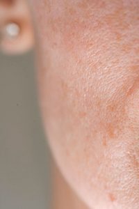 How Far Before a Wedding Should You Schedule Skin Treatments - med spa in kenner - mendoza med spa